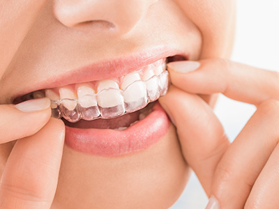 マウスピース矯正