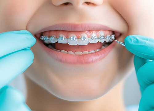 マルチブラケット