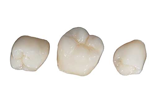 オールセラミック