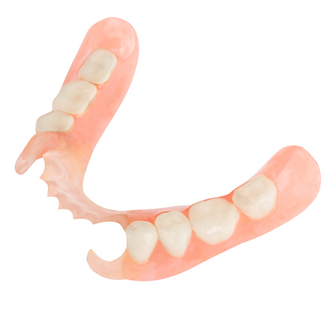 ノンクラスプデンチャー