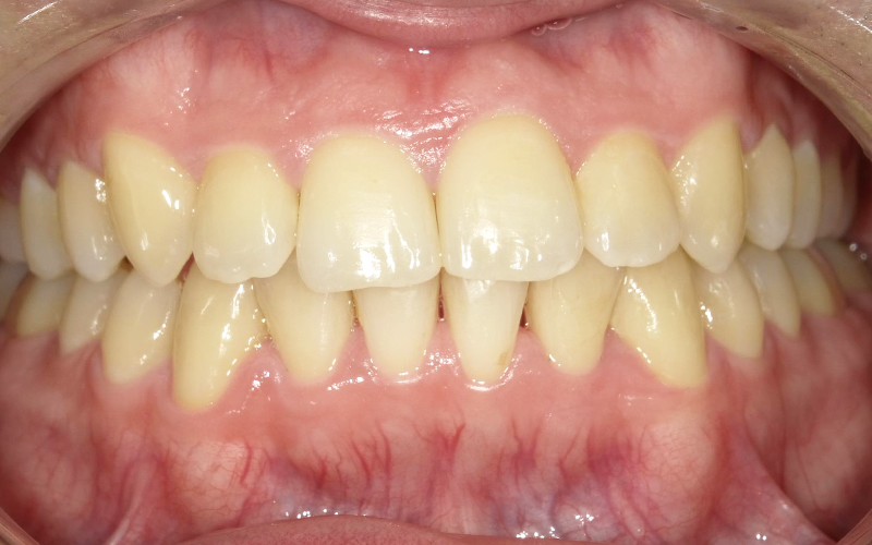 ブラケット矯正 after