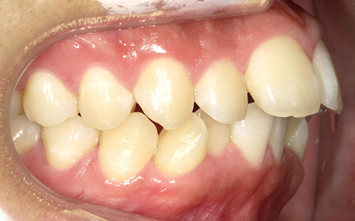 上顎前突(じょうがくぜんとつ)