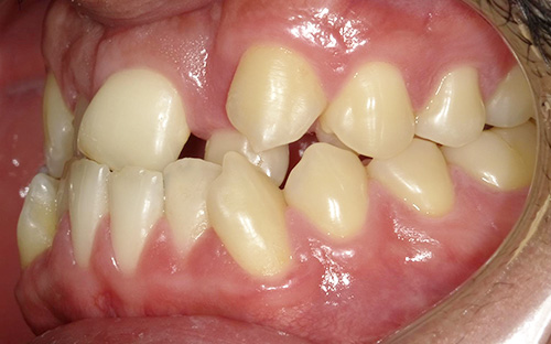 下顎前突(がかくぜんとつ)