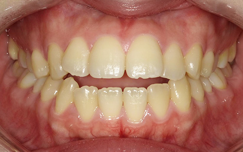 開咬(かいこう)