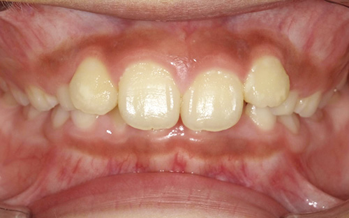 過蓋咬合(かがいこうごう)