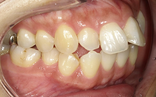 上下顎前突(じょうかがくぜんとつ)