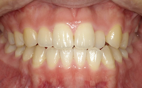 交叉咬合(こうさこうごう)