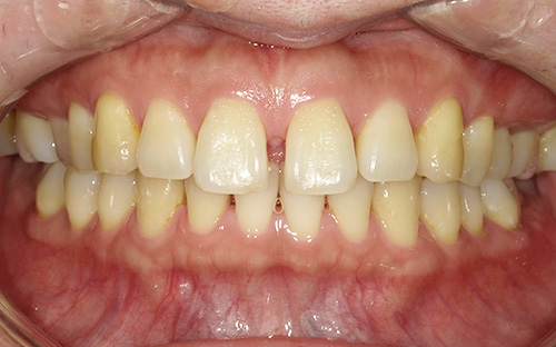 空隙歯列(くうげきしれつ)